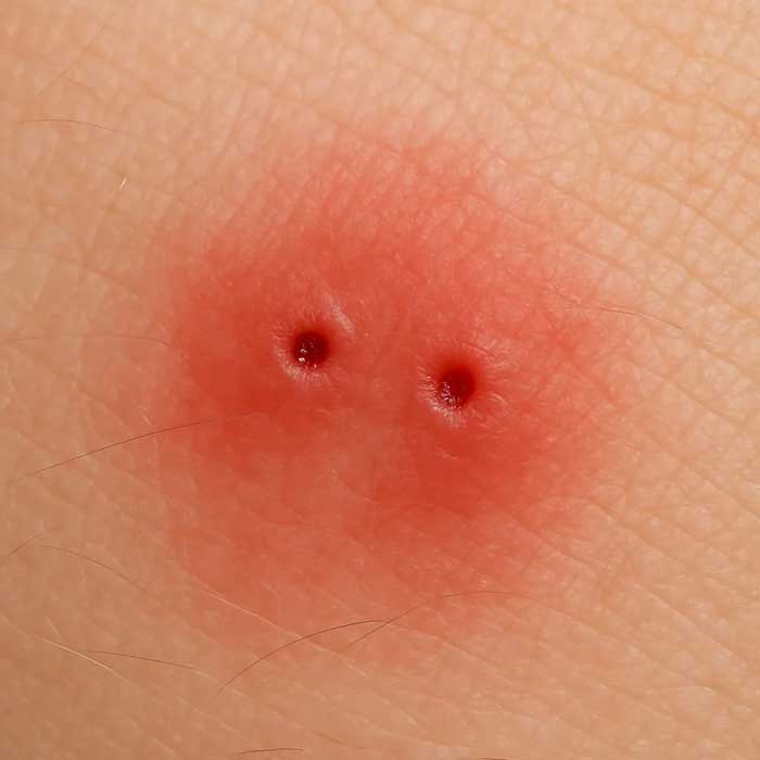 Τσίμπημα από σαρανταποδρούσα